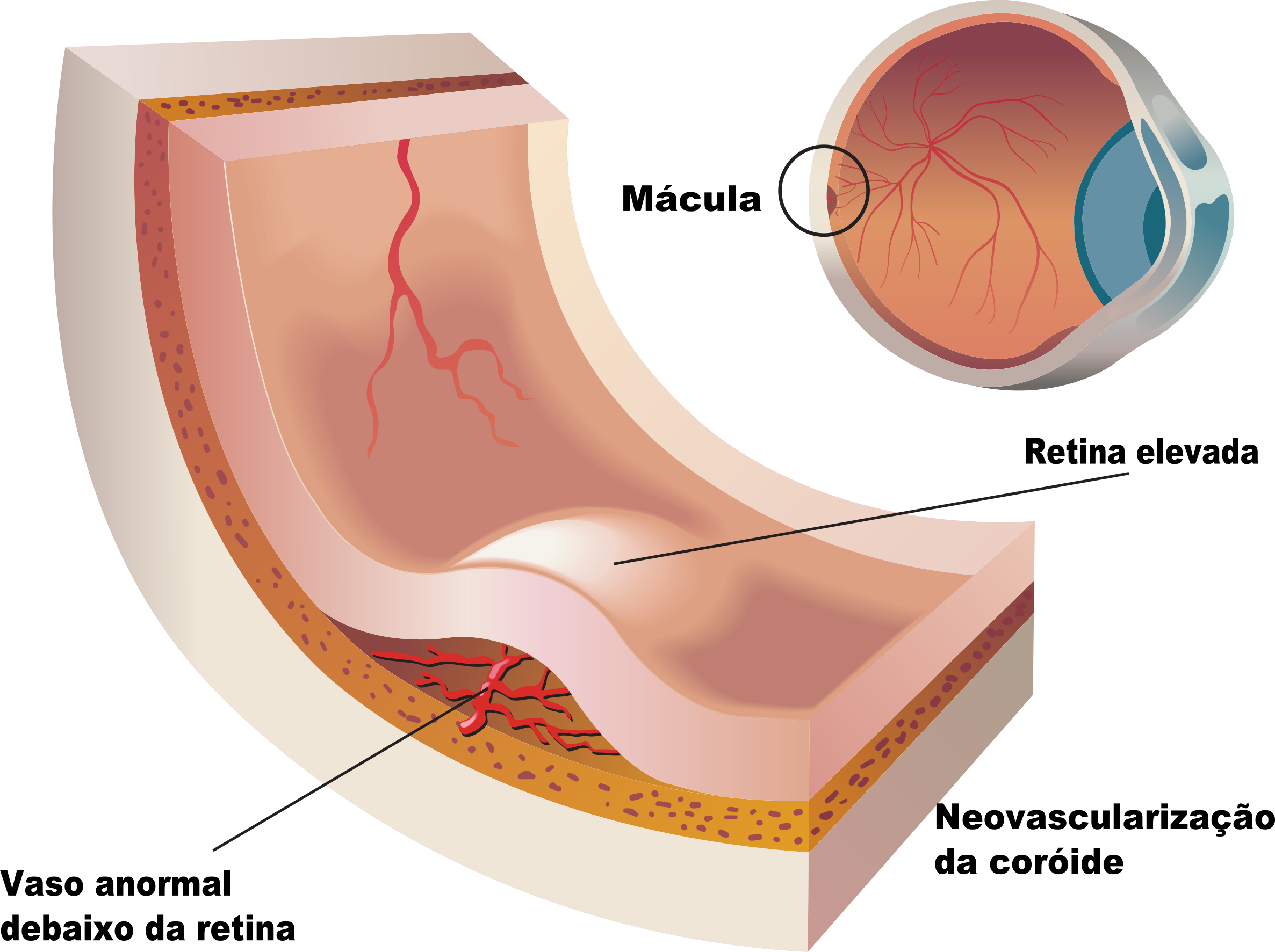 Tratamento da Retina - Instituto de Moléstias Oculares