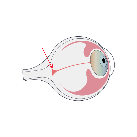 Clínica Preti Eye - Prof. Dr. Rony Preti - Especialista em Amaurose congênita de Leber