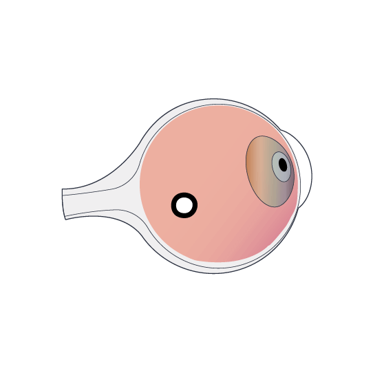 Clínica Preti Eye - Prof. Dr. Rony Preti - Especialista em Buraco macular