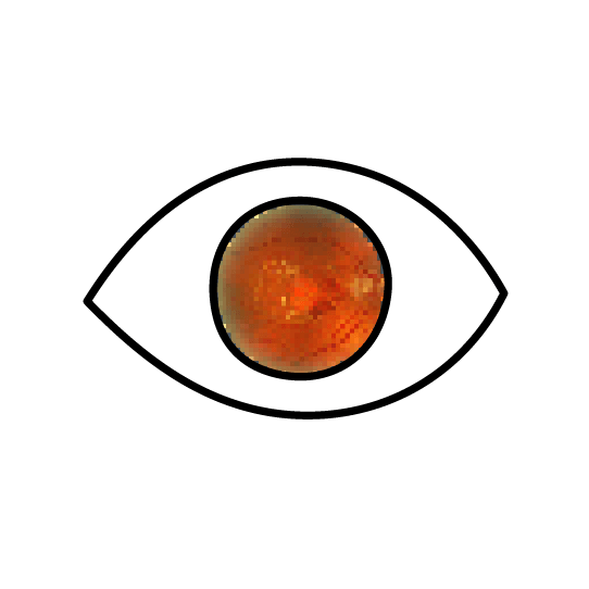 Clínica Preti Eye - Prof. Dr. Rony Preti - Especialista em Degeneração Macular