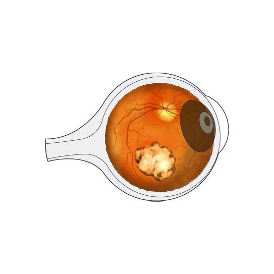 Clínica Preti Eye - Prof. Dr. Rony Preti - Especialista em Toxoplasmose ocular